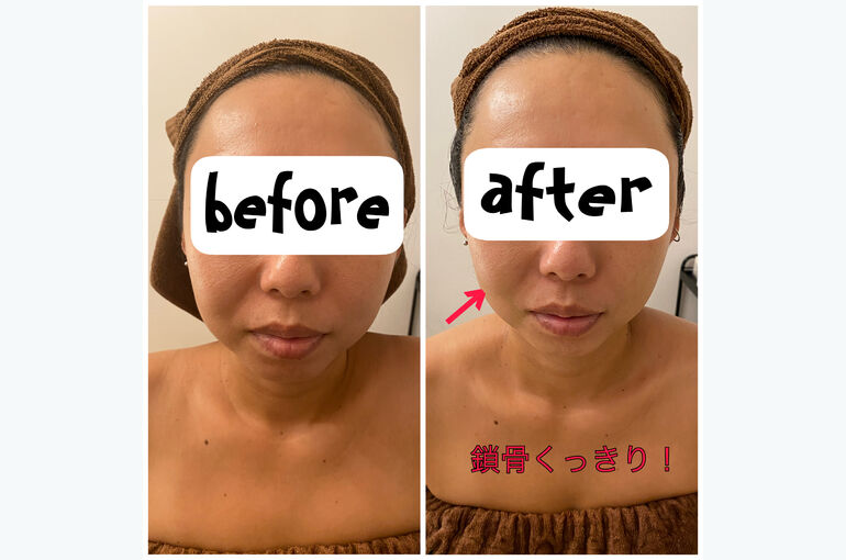 リフトアップ