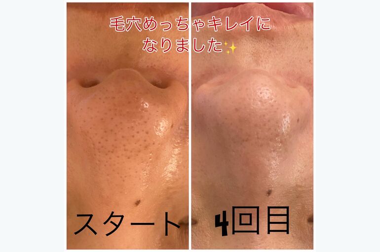 小鼻